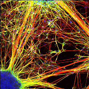 schizophrenia patient-derived iPSCs