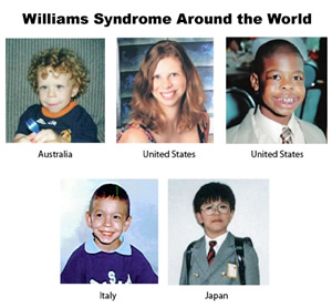 Williams syndrome