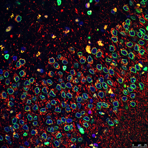 genetic mutation involved in Parkinson's