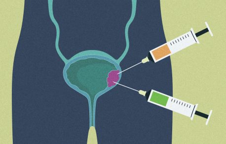 Two syringes representing experimental PIN1 inhibitor sulfopin and simvastatin being injected into a bladder tumor, symbolizing the experimental treatment combination against bladder cancer.