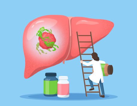 A scientist carrying supplements—like UDCA—climbs a ladder toward a liver containing a bile acid-surrounded tumor.